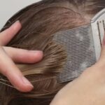 How to Get Rid of Head Lice and Keep Them Away